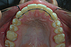 Appareils de contention (fils collés, gouttières post orthodontiques...)