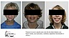 traitement orthodontique chez les 5 – 9 ans