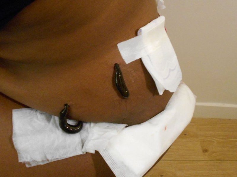 Traitement des vergetures