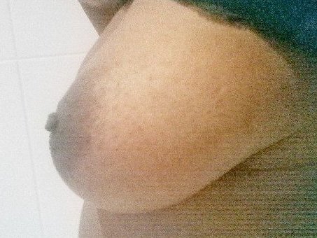 Sein gauche après séances