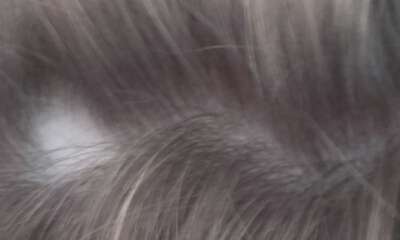 Hirudothérapie contre Alopécie