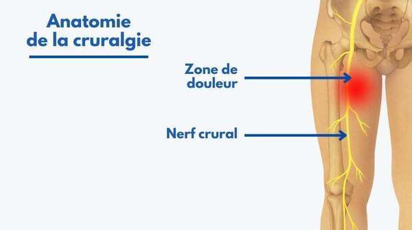Cruralgie : soulager la douleur et retrouver la fluidité du mouvement grâce à une approche globale