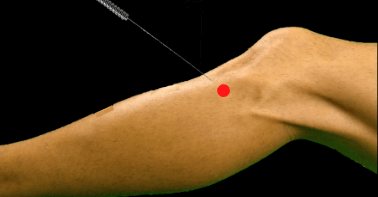 VB34 – Yang Ling Quan, le point des tendons et de la mobilité