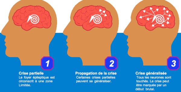 Crise d’épilepsie : comprendre, sécuriser et accompagner le corps autrement
