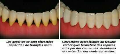Mes dents bougent que faire ?