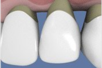 La rétraction des gencives après un traitement parodontal