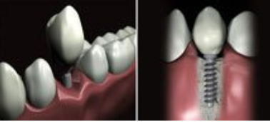 Cas clinique : Les implants dentaires