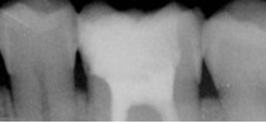 Cas clinique : Traitements endodontiques