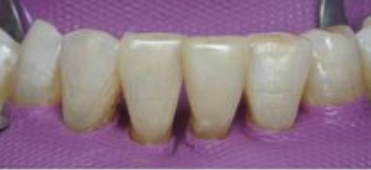 Cas clinique : Dentisterie Adhésive / Dentisterie Esthétique