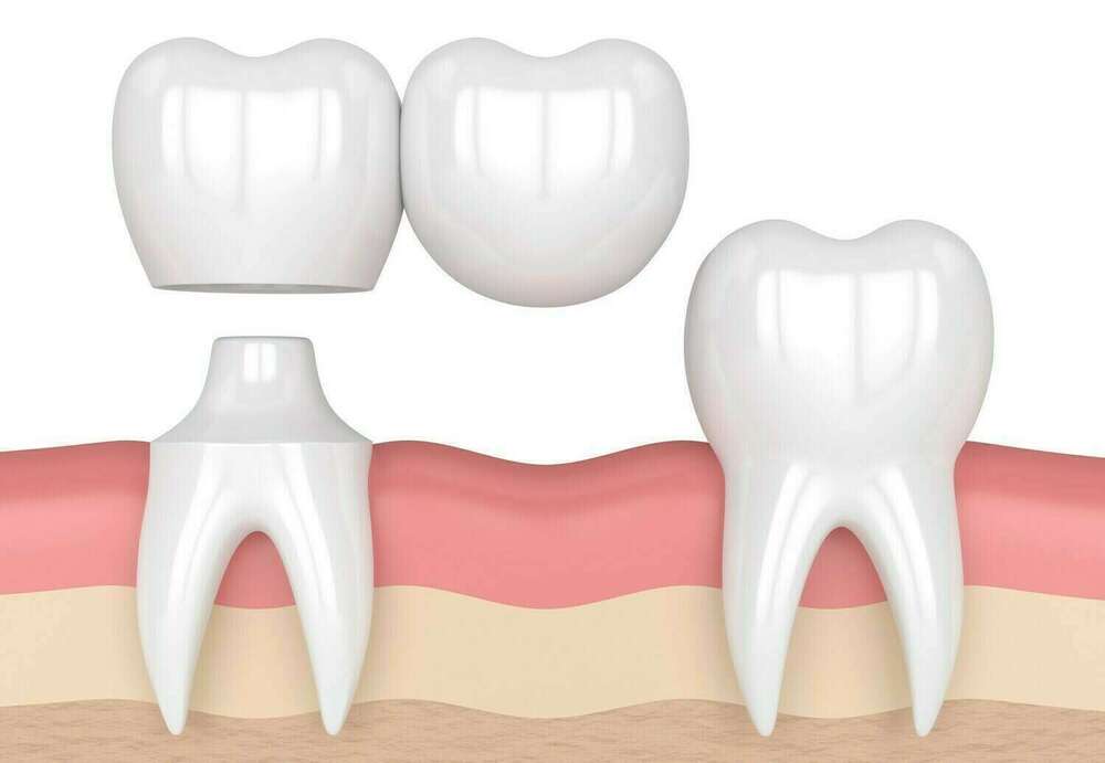 Bridge cantilever et bridge collé