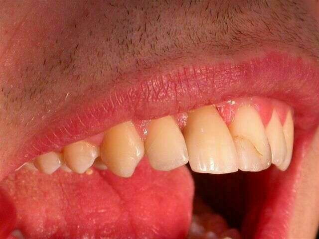 Remplacement d'une incisive du haut par un implant