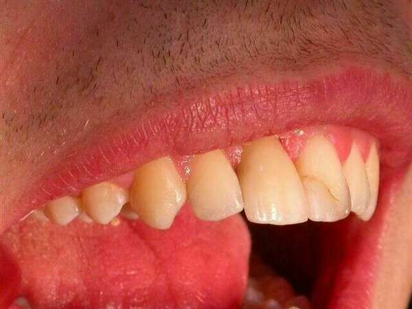 Remplacement d'une incisive du haut par un implant