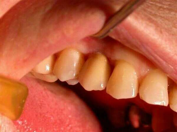 Couronnes sur des prémolaires du haut