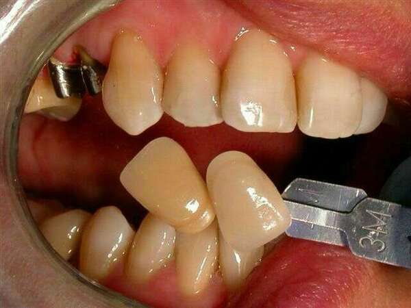 Couronnes sur des prémolaires du haut (2)