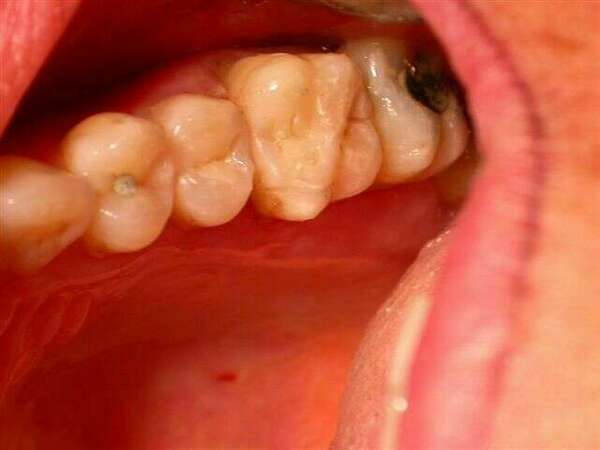 Onlays à droite et à gauche sur des dents vivantes