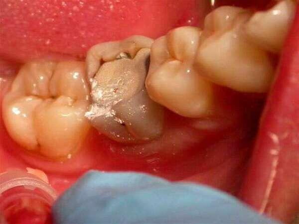 Couronnes céramiques sur des molaires du bas
