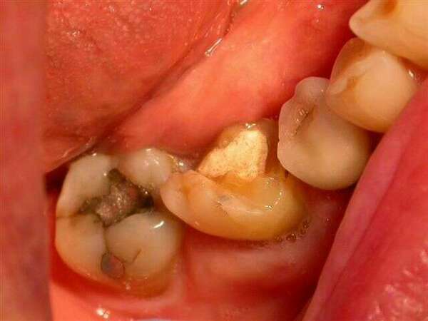 Couronne sur molaire du bas tres délabrée