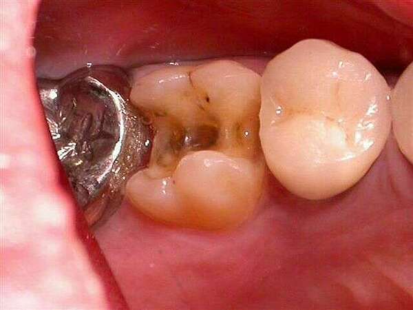 Onlay sur une molaire supérieure.