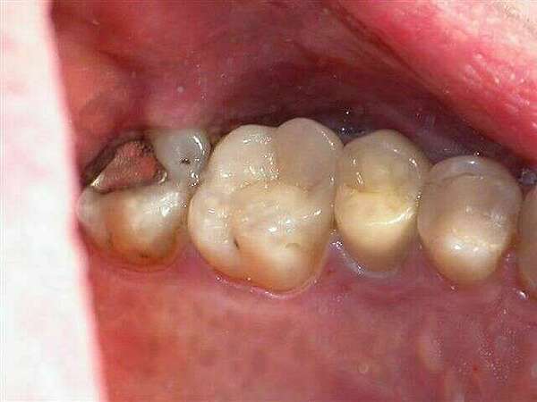 Onlay complexe sur molaire supérieure tres delabrée