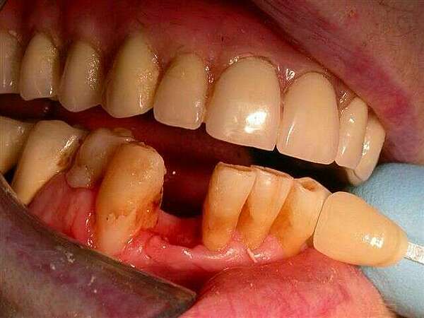 Remplacement d'une incisive du bas par un implant