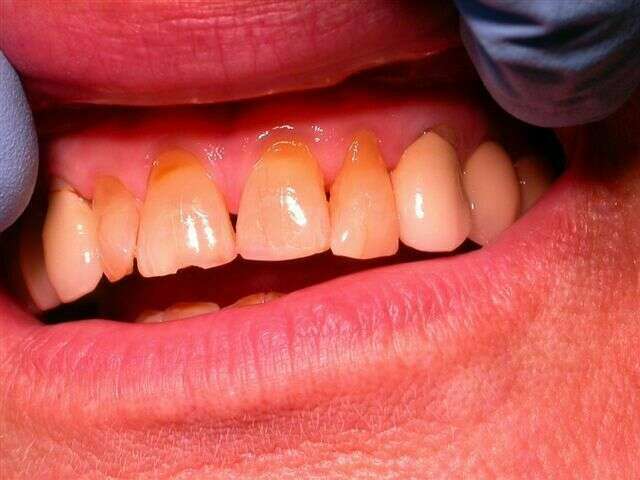 Facettes sur incisives du haut realisées en 1 seance.