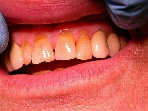 Facettes sur incisives du haut realisées en 1 seance.