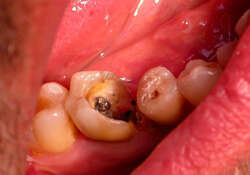 Couronne sur une molaire du bas pour permettre sa sauvegarde.