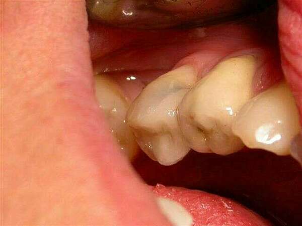 Cas d'onlay sur une prémolaire du bas