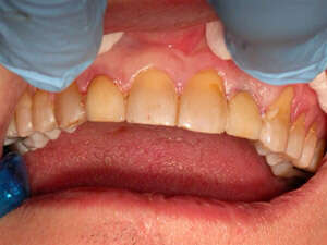 Pose de 4 facettes sur les incisives du haut