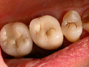 Remplacement d'une molaire supérieure