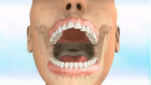 Carrière motion Classe II