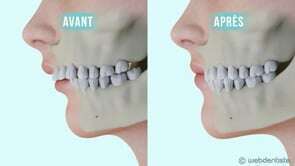 La chirurgie orthognatique – rétrognathie mandibulaire
