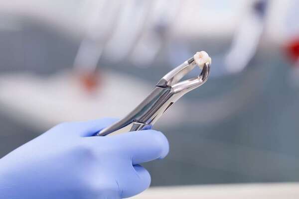 Les extractions dentaires