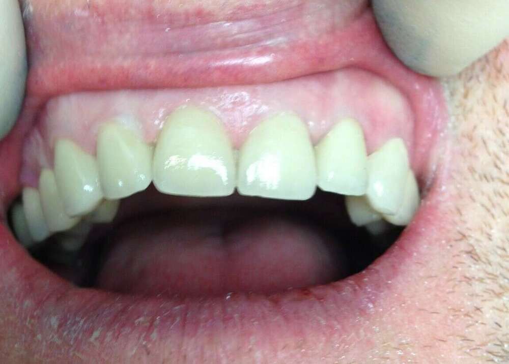 COMMENT MASQUER LES EFFETS DE LA TÉTRACYCLINE SUR LES DENTS ?