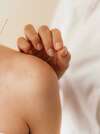 acupuncture