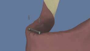 Stabilisation d'une prothèse par une barre sur 2 implants