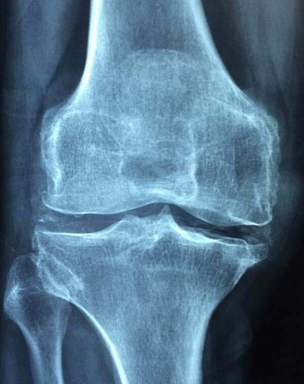 Qu'est ce que l'arthrose 