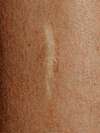 Chirurgie dermatologique à Bordeaux pour retirer les lésions cutanées
