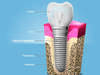 implant dentaire paris 20
