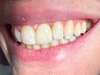implant dentaire paris 20
