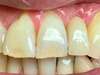 implants dentaires paris 20