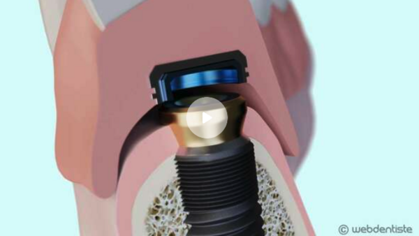 prothèse montmartre