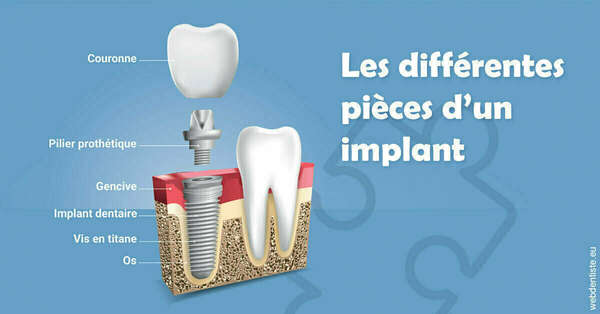 Les différentes pièces d’un implant
