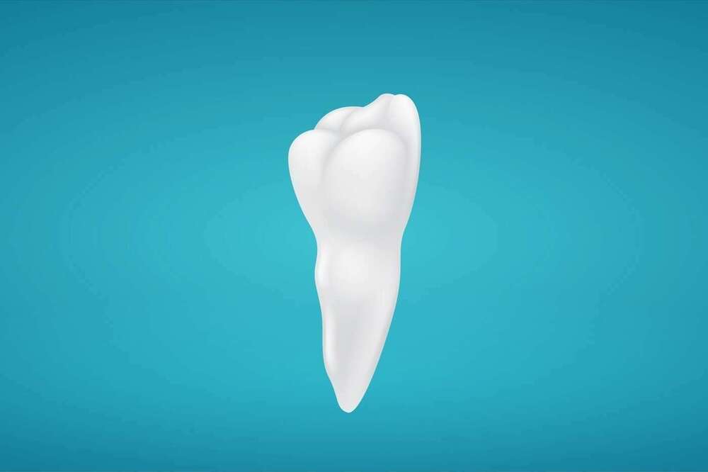 Dégagement orthodontique d’une canine incluse