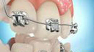 LE SYSTEME DAMON CLEAR