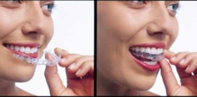 L'ORTHODONTIE INVISIBLE