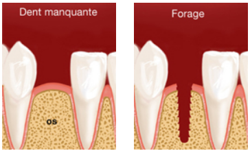 Pose d'implants dentaires au cabinet dentaire du Dr Vermot à Besançon