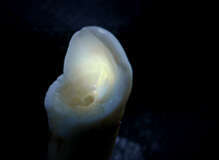 Le blanchiment dentaire au cabinet dentaire du Dr Vermot à Besançon