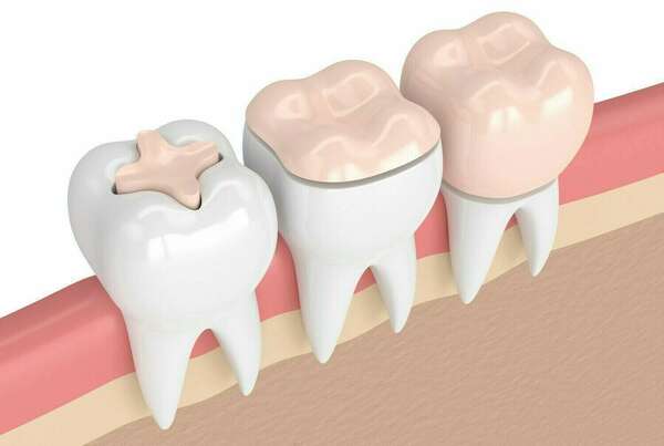 Inlay et onlay, une technique conservatrice