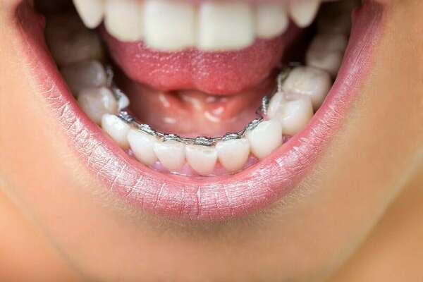 L’orthodontie linguale